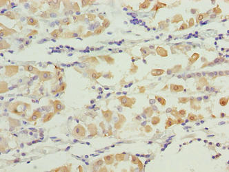 SMG6 Antibody - Immunohistochemistry of paraffin-embedded human gastric cancer using SMG6 Antibody at dilution of 1:100