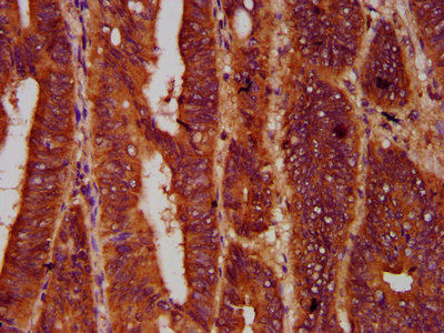 SMG7 Antibody - Immunohistochemistry Dilution at 1:600 and staining in paraffin-embedded human colon cancer performed on a Leica BondTM system. After dewaxing and hydration, antigen retrieval was mediated by high pressure in a citrate buffer (pH 6.0). Section was blocked with 10% normal Goat serum 30min at RT. Then primary antibody (1% BSA) was incubated at 4°C overnight. The primary is detected by a biotinylated Secondary antibody and visualized using an HRP conjugated SP system.