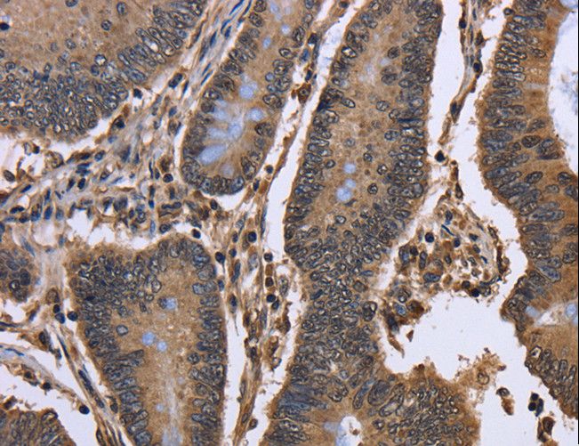 SMIF / DCP1A Antibody - Immunohistochemistry of paraffin-embedded Human colon cancer using DCP1A Polyclonal Antibody at dilution of 1:50.