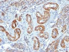 SMMHC / MYH11 Antibody - Formalin-fixed, paraffin-embedded human Leiomyosarcoma stained with SM-MHC antibody (ID8).  This image was taken for the unmodified form of this product. Other forms have not been tested.