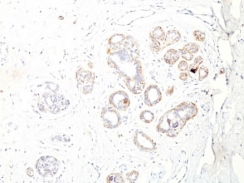 SMMHC / MYH11 Antibody - Formalin-fixed, paraffin-embedded human breast carcinoma stained with SM-MHC antibody (ID8).  This image was taken for the unmodified form of this product. Other forms have not been tested.