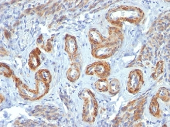 SMMHC / MYH11 Antibody - Formalin-fixed, paraffin-embedded human Leiomyosarcoma stained with SM-MHC antibody (ID8).  This image was taken for the unmodified form of this product. Other forms have not been tested.