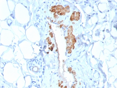 SMMHC / MYH11 Antibody - Formalin-fixed, paraffin-embedded human Breast Carcinoma stained with SM-MHC Recombinant Rabbit Monoclonal Antibody (MYH11/2303R).