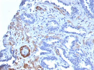 SMMHC / MYH11 Antibody - Formalin-fixed, paraffin-embedded human Prostate Carcinoma stained with SM-MHC Recombinant Rabbit Monoclonal Antibody (MYH11/2303R).
