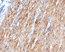 SMMHC / MYH11 Antibody - Formalin-fixed, paraffin-embedded human colon carcinoma stained with SMMHC antibody (MYH11/923).  This image was taken for the unmodified form of this product. Other forms have not been tested.