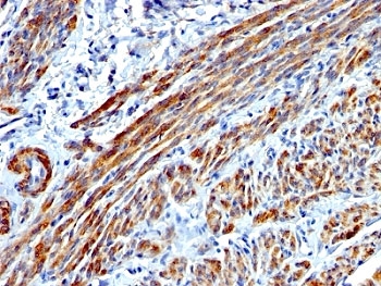 SMMHC / MYH11 Antibody - Formalin-fixed, paraffin-embedded human Leiomyosarcoma stained with SMMHC antibody (MYH11/923).  This image was taken for the unmodified form of this product. Other forms have not been tested.