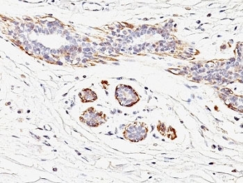 SMMHC / MYH11 Antibody - Formalin-fixed, paraffin-embedded human breast carcinoma stained with SMMHC antibody (MYH11/923).  This image was taken for the unmodified form of this product. Other forms have not been tested.