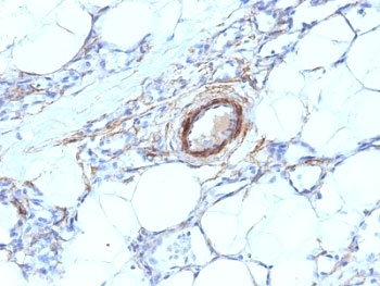SMMHC / MYH11 Antibody - Formalin-fixed, paraffin-embedded human angiosarcoma stained with SMMHC antibody (MYH11/923).  This image was taken for the unmodified form of this product. Other forms have not been tested.
