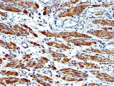 SMMHC / MYH11 Antibody - Formalin-fixed, paraffin-embedded human Leiomyosarcoma stained with SMMHC antibody (MYH11/923 + SMMS-1).  This image was taken for the unmodified form of this product. Other forms have not been tested.