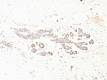 SMMHC / MYH11 Antibody - Formalin-fixed, paraffin-embedded human breast carcinoma stained with SMMHC antibody (MYH11/923 + SMMS-1).  This image was taken for the unmodified form of this product. Other forms have not been tested.