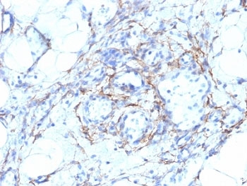 SMMHC / MYH11 Antibody - Formalin-fixed, paraffin-embedded human angiosarcoma stained with SMMHC antibody (MYH11/923 + SMMS-1).  This image was taken for the unmodified form of this product. Other forms have not been tested.