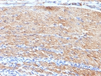 SMMHC / MYH11 Antibody - Formalin-fixed, paraffin-embedded human colon carcinoma stained with SMMHC antibody (MYH11/923 + SMMS-1).  This image was taken for the unmodified form of this product. Other forms have not been tested.