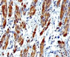 SMMHC / MYH11 Antibody - IHC testing of FFPE human Leiomyosarcoma with SMMHC antibody (clone SMM11-1).  This image was taken for the unmodified form of this product. Other forms have not been tested.