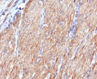 SMMHC / MYH11 Antibody - IHC testing of FFPE human colon carcinoma with SMMHC antibody (clone SMM11-1).  This image was taken for the unmodified form of this product. Other forms have not been tested.