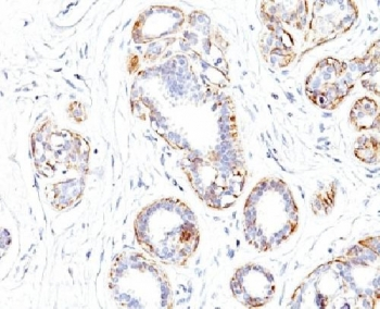 SMMHC / MYH11 Antibody - IHC testing of FFPE human breast carcinoma with SM-MHC antibody (clone SMMS-1).