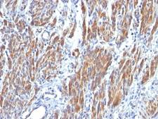 SMMHC / MYH11 Antibody - Formalin-fixed, paraffin-embedded human Leiomyosarcoma stained with SM-MHC antibody (SMMS-1).  This image was taken for the unmodified form of this product. Other forms have not been tested.