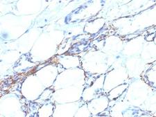 SMMHC / MYH11 Antibody - Formalin-fixed, paraffin-embedded human angiosarcoma stained with SM-MHC antibody (SPM201).  This image was taken for the unmodified form of this product. Other forms have not been tested.