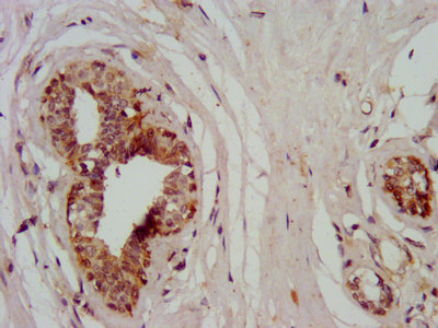 SMMHC / MYH11 Antibody - Immunohistochemistry image at a dilution of 1:400 and staining in paraffin-embedded human breast cancer performed on a Leica BondTM system. After dewaxing and hydration, antigen retrieval was mediated by high pressure in a citrate buffer (pH 6.0) . Section was blocked with 10% normal goat serum 30min at RT. Then primary antibody (1% BSA) was incubated at 4 °C overnight. The primary is detected by a biotinylated secondary antibody and visualized using an HRP conjugated SP system.