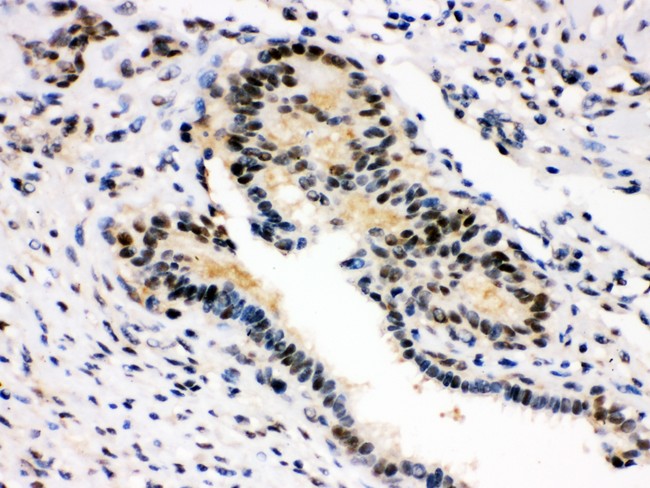 SMN1 Antibody - SMN1/2 antibody IHC-paraffin: Human Mammary Cancer Tissue.