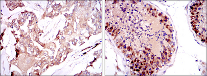 SMN1 Antibody - IHC of paraffin-embedded breast cancer tissues (left) and testis tissues (right) using SMN1 mouse monoclonal antibody with DAB staining.