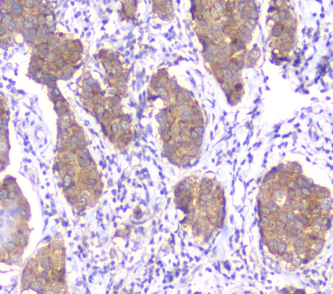SMN1 Antibody - IHC analysis of SMN1/2 using anti-SMN1/2 antibody. SMN1/2 was detected in paraffin-embedded section of human mammary cancer tissue. Heat mediated antigen retrieval was performed in citrate buffer (pH6, epitope retrieval solution) for 20 mins. The tissue section was blocked with 10% goat serum. The tissue section was then incubated with 1µg/ml mouse anti-SMN1/2 antibody overnight at 4°C. Biotinylated goat anti-mouse IgG was used as secondary antibody and incubated for 30 minutes at 37°C. The tissue section was developed using Strepavidin-Biotin-Complex (SABC) with DAB as the chromogen.