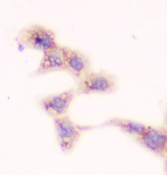 SMN1 Antibody - IHC analysis of SMN1/2 using anti-SMN1/2 antibody. SMN1/2 was detected in immunocytochemical section of A431 cell. Heat mediated antigen retrieval was performed in citrate buffer (pH6, epitope retrieval solution) for 20 mins. The tissue section was blocked with 10% goat serum. The tissue section was then incubated with 1µg/ml mouse anti-SMN1/2 antibody overnight at 4°C. Biotinylated goat anti-mouse IgG was used as secondary antibody and incubated for 30 minutes at 37°C. The tissue section was developed using Strepavidin-Biotin-Complex (SABC) with DAB as the chromogen.