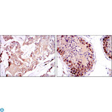 SMN1 Antibody - Immunohistochemistry (IHC) analysis of paraffin-embedded breast cancer tissues (left) and testis tissues (right) with DAB staining using SMN1 Monoclonal Antibody.