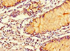 SMOC1 Antibody - Immunohistochemistry of paraffin-embedded human colon cancer at dilution 1:100