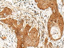 SMOC1 Antibody - Immunohistochemistry of paraffin-embedded Human esophagus cancer tissue  using SMOC1 Polyclonal Antibody at dilution of 1:50(×200)