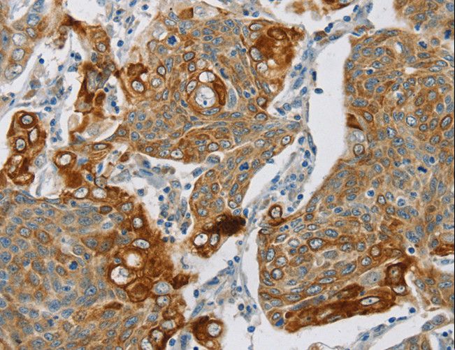 SMOC2 Antibody - Immunohistochemistry of paraffin-embedded Human cervical cancer using SMOC2 Polyclonal Antibody at dilution of 1:30.