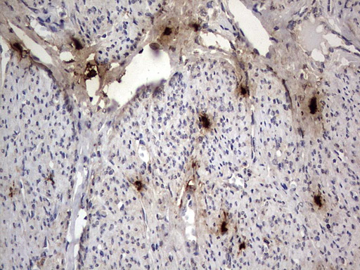 SMPD1 / Acid Sphingomyelinase Antibody - IHC of paraffin-embedded Adenocarcinoma of Human endometrium tissue using anti-SMPD1 mouse monoclonal antibody. (Heat-induced epitope retrieval by 1 mM EDTA in 10mM Tris, pH8.5, 120°C for 3min).