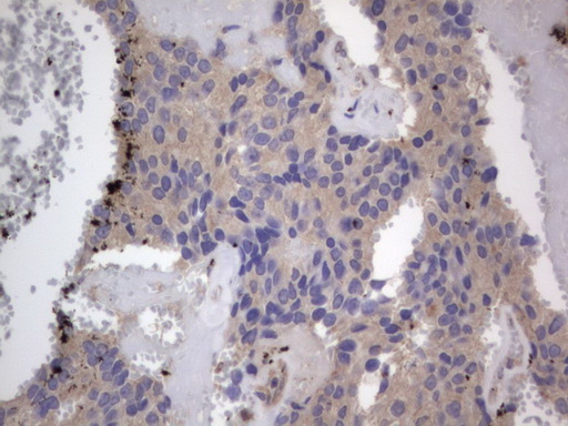 SMPD1 / Acid Sphingomyelinase Antibody - IHC of paraffin-embedded Adenocarcinoma of Human breast tissue using anti-SMPD1 mouse monoclonal antibody. (Heat-induced epitope retrieval by 1 mM EDTA in 10mM Tris, pH8.5, 120°C for 3min).