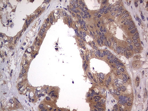 SMPD1 / Acid Sphingomyelinase Antibody - IHC of paraffin-embedded Adenocarcinoma of Human colon tissue using anti-SMPD1 mouse monoclonal antibody. (Heat-induced epitope retrieval by 1 mM EDTA in 10mM Tris, pH8.5, 120°C for 3min).