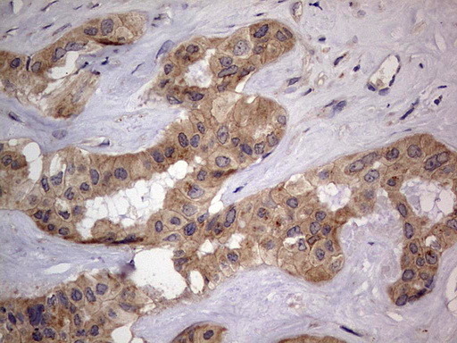 SMPD1 / Acid Sphingomyelinase Antibody - IHC of paraffin-embedded Carcinoma of Human liver tissue using anti-SMPD1 mouse monoclonal antibody. (Heat-induced epitope retrieval by 1 mM EDTA in 10mM Tris, pH8.5, 120°C for 3min).
