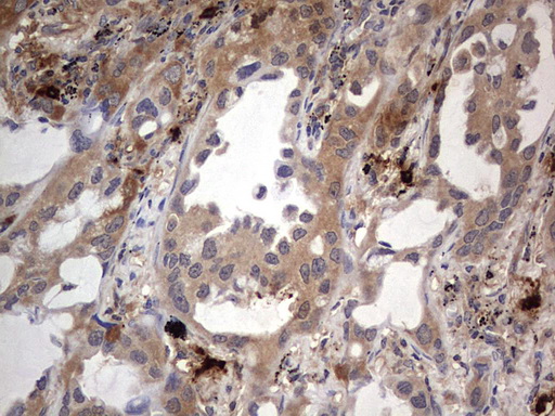 SMPD1 / Acid Sphingomyelinase Antibody - IHC of paraffin-embedded Carcinoma of Human lung tissue using anti-SMPD1 mouse monoclonal antibody. (Heat-induced epitope retrieval by 1 mM EDTA in 10mM Tris, pH8.5, 120°C for 3min).