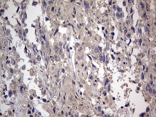 SMPD1 / Acid Sphingomyelinase Antibody - IHC of paraffin-embedded Adenocarcinoma of Human ovary tissue using anti-SMPD1 mouse monoclonal antibody. (Heat-induced epitope retrieval by 1 mM EDTA in 10mM Tris, pH8.5, 120°C for 3min).