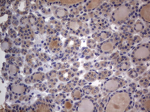 SMPD1 / Acid Sphingomyelinase Antibody - IHC of paraffin-embedded Carcinoma of Human thyroid tissue using anti-SMPD1 mouse monoclonal antibody. (Heat-induced epitope retrieval by 1 mM EDTA in 10mM Tris, pH8.5, 120°C for 3min).