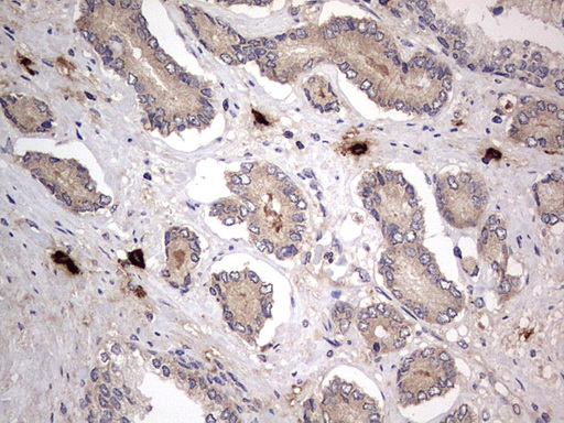 SMPD1 / Acid Sphingomyelinase Antibody - IHC of paraffin-embedded Human prostate tissue using anti-SMPD1 mouse monoclonal antibody. (Heat-induced epitope retrieval by 1 mM EDTA in 10mM Tris, pH8.5, 120°C for 3min).