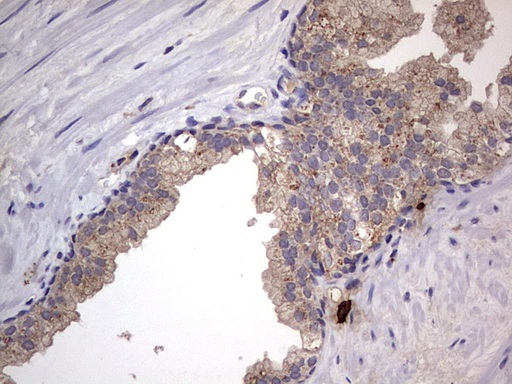 SMPD1 / Acid Sphingomyelinase Antibody - IHC of paraffin-embedded Carcinoma of Human prostate tissue using anti-SMPD1 mouse monoclonal antibody. (Heat-induced epitope retrieval by 1 mM EDTA in 10mM Tris, pH8.5, 120°C for 3min).