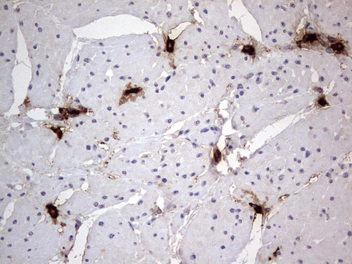 SMPD1 / Acid Sphingomyelinase Antibody - IHC of paraffin-embedded Human bladder tissue using anti-SMPD1 mouse monoclonal antibody. (Heat-induced epitope retrieval by 1 mM EDTA in 10mM Tris, pH8.5, 120°C for 3min).