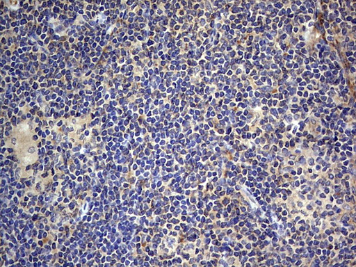 SMPD1 / Acid Sphingomyelinase Antibody - IHC of paraffin-embedded Human lymphoma tissue using anti-SMPD1 mouse monoclonal antibody. (Heat-induced epitope retrieval by 1 mM EDTA in 10mM Tris, pH8.5, 120°C for 3min).