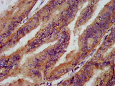 SMPD2 Antibody - Immunohistochemistry image at a dilution of 1:200 and staining in paraffin-embedded human endometrial cancer performed on a Leica BondTM system. After dewaxing and hydration, antigen retrieval was mediated by high pressure in a citrate buffer (pH 6.0) . Section was blocked with 10% normal goat serum 30min at RT. Then primary antibody (1% BSA) was incubated at 4 °C overnight. The primary is detected by a biotinylated secondary antibody and visualized using an HRP conjugated SP system.