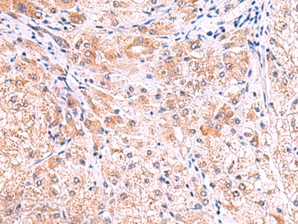 SMPD2 Antibody - Immunohistochemistry of paraffin-embedded Human liver cancer tissue  using SMPD2 Polyclonal Antibody at dilution of 1:70(×200)
