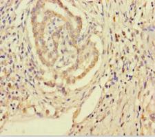 SMPD3 / NSMASE2 Antibody - Immunohistochemistry of paraffin-embedded human pancreatic cancer using SMPD3 Antibody at dilution of 1:100