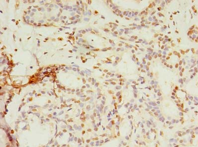 SMPDL3A Antibody - Immunohistochemistry of paraffin-embedded human breast cancer using antibody at dilution of 1:100.