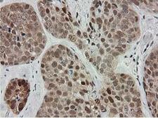 SMS / Spermine Synthase Antibody - IHC of paraffin-embedded Adenocarcinoma of Human breast tissue using anti-SMS mouse monoclonal antibody.