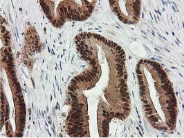 SMS / Spermine Synthase Antibody - IHC of paraffin-embedded Adenocarcinoma of Human colon tissue using anti-SMS mouse monoclonal antibody.