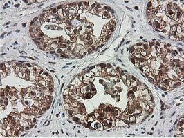 SMS / Spermine Synthase Antibody - IHC of paraffin-embedded Adenocarcinoma of Human ovary tissue using anti-SMS mouse monoclonal antibody.