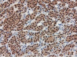 SMS / Spermine Synthase Antibody - IHC of paraffin-embedded Carcinoma of Human thyroid tissue using anti-SMS mouse monoclonal antibody.