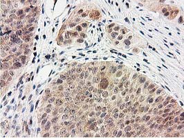SMS / Spermine Synthase Antibody - IHC of paraffin-embedded Carcinoma of Human bladder tissue using anti-SMS mouse monoclonal antibody.